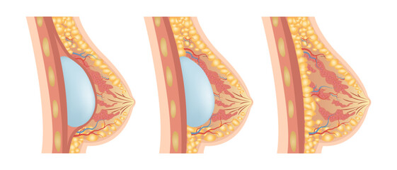 Breast Implant Placement Diagram. Subglandular and Submuscular Placement Types. Medical Illustration of Breast Implant Plastic Surgery