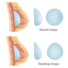 Breast augmentation with implant or breast surgery, injection of silicone gel using prepectoral and subpectoral technique,