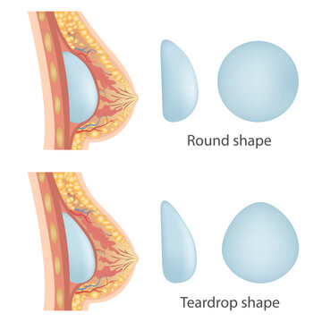 Breast augmentation with implant or breast surgery, injection of silicone gel using prepectoral and subpectoral technique,