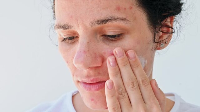 Face, cream and a woman with skin care. Problematic skin of a young girl in close-up. Pimples, acne, pores, scars. Genuine leather without filters. slow motion