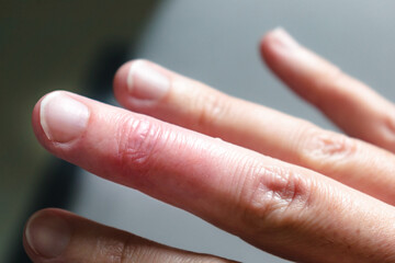 Mallet finger healing after splint removal from middle finger following joint trauma