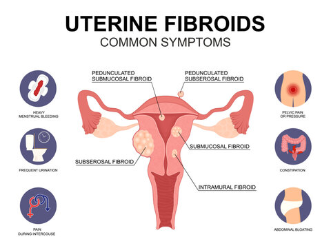 Uterine Fibroids Types and Symptoms. Medical vector illustration.