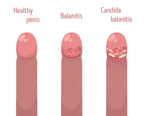 Healthy and inflamed penis. Candida balanitis. Vector illustration.