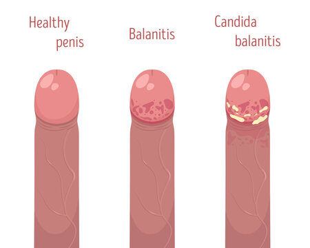 Healthy and inflamed penis. Candida balanitis. Vector illustration.