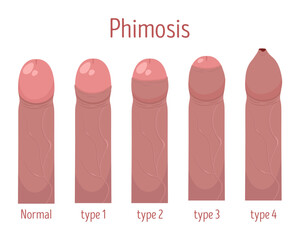 Poster about types of phimosis. Types of phimosis. Vector illustration.
