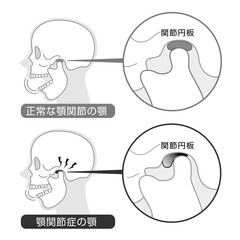 顎関節症の症状と説明のイラスト　モノトーン