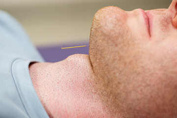 CloseUp of a Patient Receiving Acupuncture Treatment on the Chin