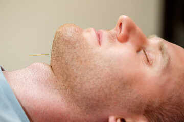 Fototapeta premium Experience profound deep relaxation and exceptional healing benefits through the power of acupuncture, specifically designed to offer effective stress relief in our demanding, fastpaced world