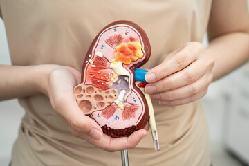 Chronic kidney disease, Asian woman with model for treatment urinary system, urology, Estimated...