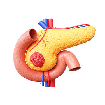 Pancreatic cancer anatomy concept