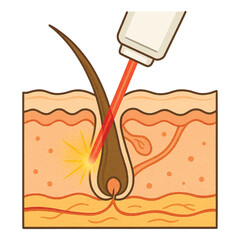 Vector cross sectional illustration of human skin during laser hair removal. The image shows epidermis, dermis and subcutaneous layers, with a hair follicle. Isolated design on white background.