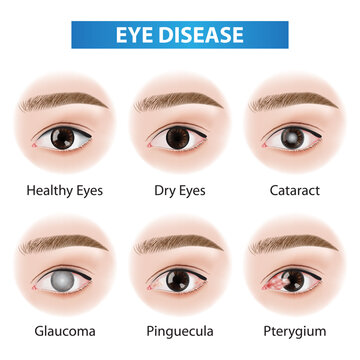 Eye diseases problem vector illustration