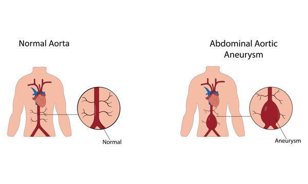 Abdominal aortic aneurysm vector illustration