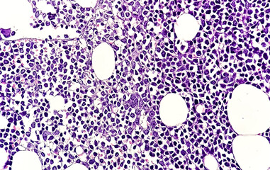 Microscopic image of Trephine Biopsy showing Acute Leukemia, Bone marrow biopsy