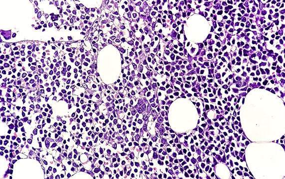 Microscopic image of Trephine Biopsy showing Acute Leukemia, Bone marrow biopsy