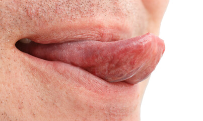 Fototapeta premium A man's tongue is red and swollen