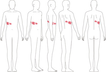 帯状疱疹の症状。正面から側面背面の人間のイラスト