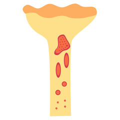 Osteomyelitis Microbiology. Vector illustration in flat style.