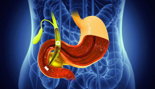 Gallstones removing in the Gallbladder. 3d illustration