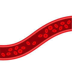 Blood vessel flow and arteriosclerosis. Atherosclerosis Diagram. Vector illustration.
