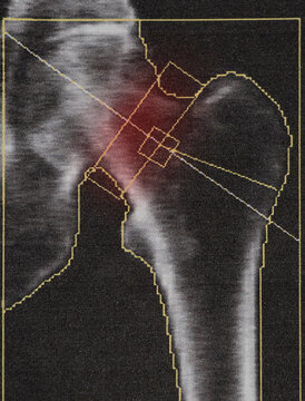 Bone density diagnostics of the femur of an elderly woman with severe osteoporosis, medical examination