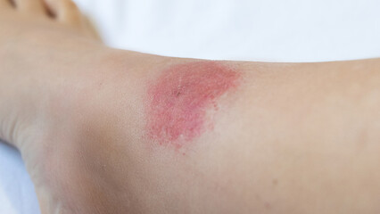 Fototapeta premium allergic reaction to an insect bite. Allergy to wasp and mosquito bites