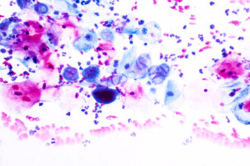 Genital herpes infection by the herpes simplex virus (HSV) of the genitals.Ground glass appearance criteria for pap smear slide cytology and pathology.Human cell medical concept.