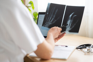 Doctor pointing at a hand x-ray while examining a metacarpal fracture during a medical...