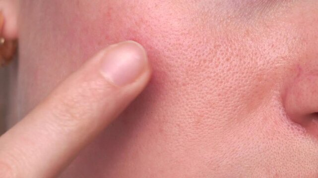 Macro close-up of a woman pointing to acne and enlarged pores on her red irritated cheek. Skin texture and blemish detail for dermatology, skincare or cosmetics concept.
