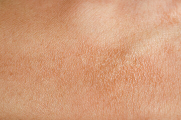 Texture of skin with scar as background, closeup