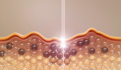 Laser beam penetrating skin layers, targeting dark spots and restoring clarity. A concept of dermatological treatment, whitening, and cosmetic skincare technology.
