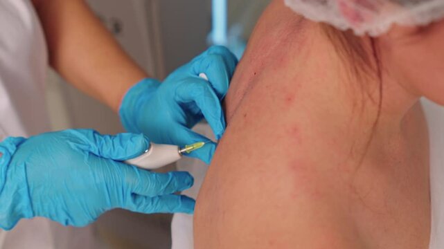 carboxytherapy. hardware injections into the patient's back. beauty and health