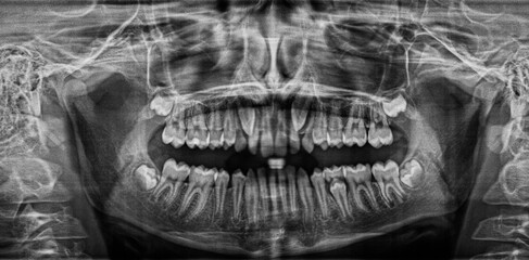 Panoramic X-ray scan of humans teeth