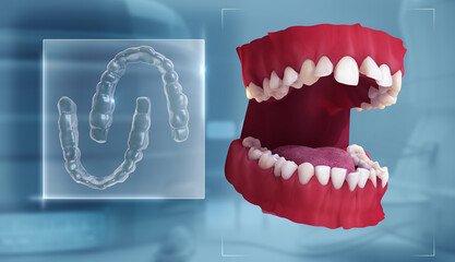 A distinctive set of clear aligner or invisalign braces or invisible retainer. Medically accurate dental 3D illustration.