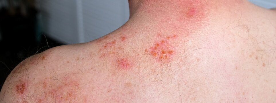 Skin lesion symptom in Shingles or Herpes zoster in person. Viral disease Varicella virus. Painful skin rash with blisters on the body. Red pimples. Insects bite. Body injury. High quality.
