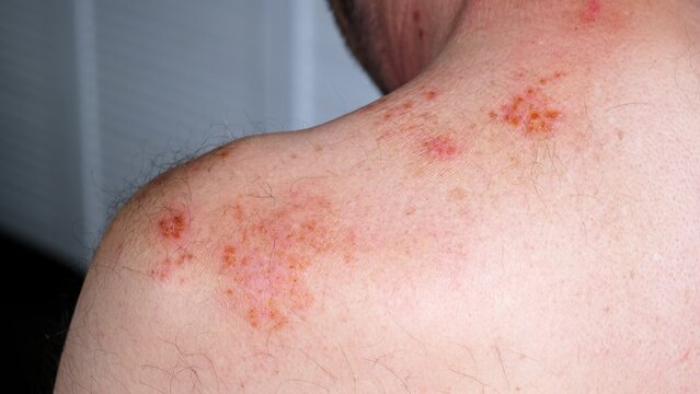 Skin lesion symptom in Shingles or Herpes zoster in person. Viral disease Varicella virus. Painful skin rash with blisters on the body. Red pimples. Insects bite. Body injury. High quality.