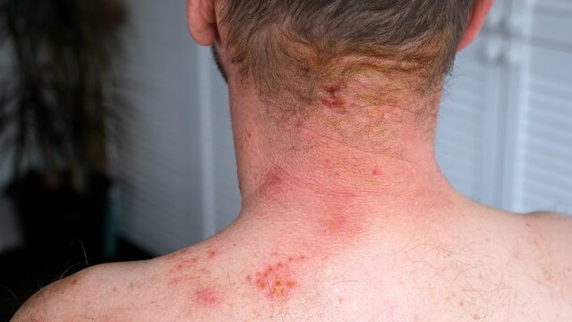 Skin lesion symptom in Shingles or Herpes zoster in person. Viral disease Varicella virus. Painful skin rash with blisters on the body. Red pimples. Insects bite. Body injury. High quality.