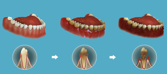 The stages of gum diseases or periodontitis.Medically accurate 3D image.