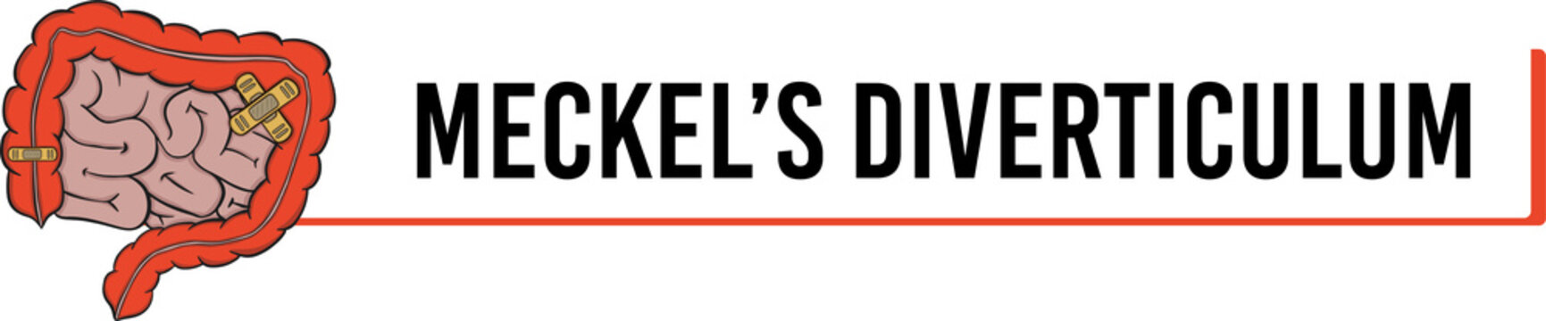 meckels diverticulum