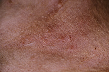 Cats may also have multiple, small crusty bumps,hair loss on both sides of the body or areas of flat, reddened, swollen skin called eosinophilic plaques