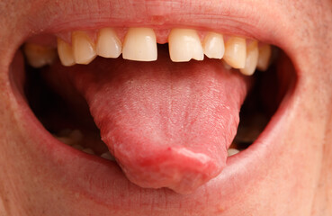 A person's tongue is red and swollen