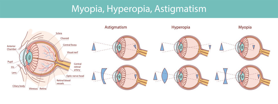 Eyesight disorders. Normal eye, Astigmatism, hyperopia and myopi
