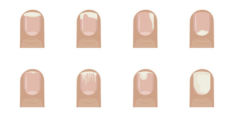 Different types of onychosis affecting fingernails are shown in medical illustration