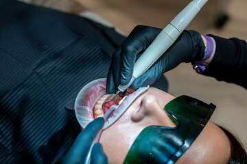 Dentist performing teeth whitening procedure using uv light and cheek retractor