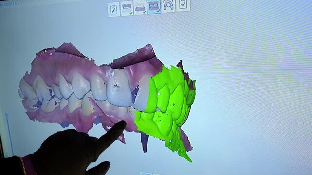 Dentist pointing at a 3d model of teeth on a computer screen, highlighting areas for potential dental work