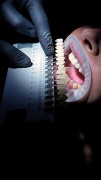 Professional dentist comparing tooth shade using color samples during teeth whitening procedure in modern dental clinic, carefully selecting optimal whitening treatment