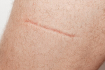 Fototapeta premium Long scar on a person’s leg, showing the natural healing process of the skin.