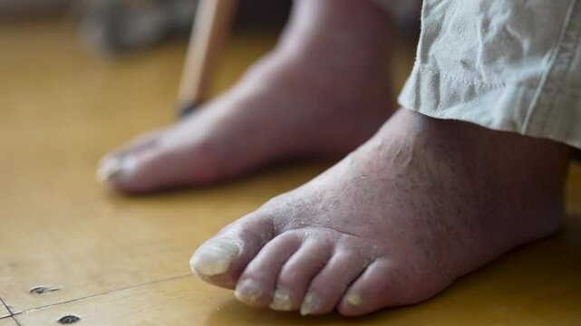 Close-up shot of an elderly person foot with fungal nail infection (onychomycosis), dry skin, and possible circulatory issues. Old man swelling legs and feet. Medical healthcare, diabetes, dermatology