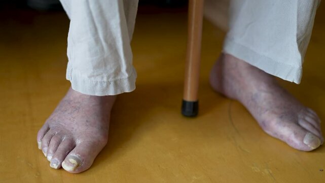 Close-up shot of an elderly person foot with fungal nail infection (onychomycosis), dry skin, and possible circulatory issues. Old man swelling legs and feet. Medical healthcare, diabetes, dermatology