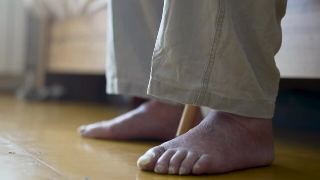 Close-up shot of an elderly person foot with fungal nail infection (onychomycosis), dry skin, and possible circulatory issues. Old man swelling legs and feet. Medical healthcare, diabetes, dermatology